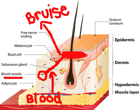 First things first: Bruises are caused by tiny injuries to your blood vessels.