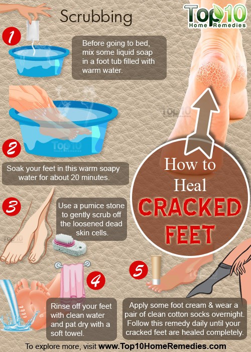 how to heal crack feet
